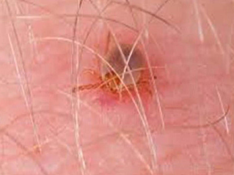 Gənə bu Avropa &ouml;lkəsini cənginə aldı  185 rayon təhl&uuml;kədədir