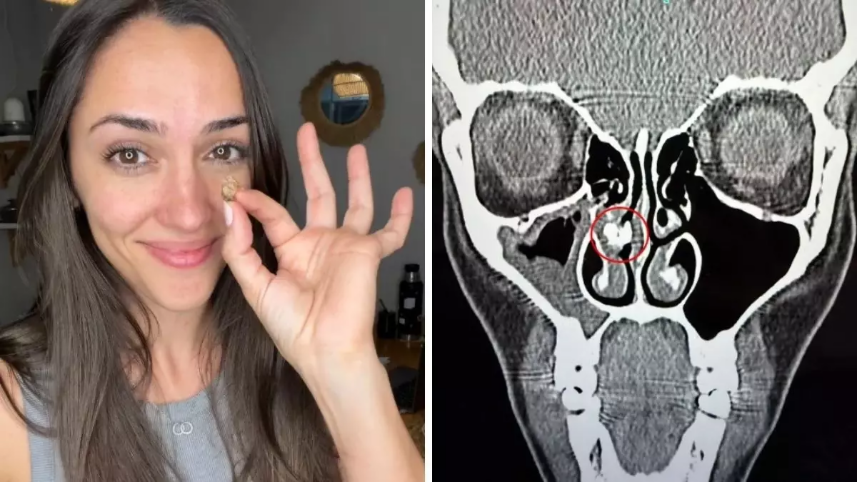 Qadının burnundan g&ouml;r&uuml;n nə &ccedil;ıxdı  35 ildir belə yaşayıbmış...