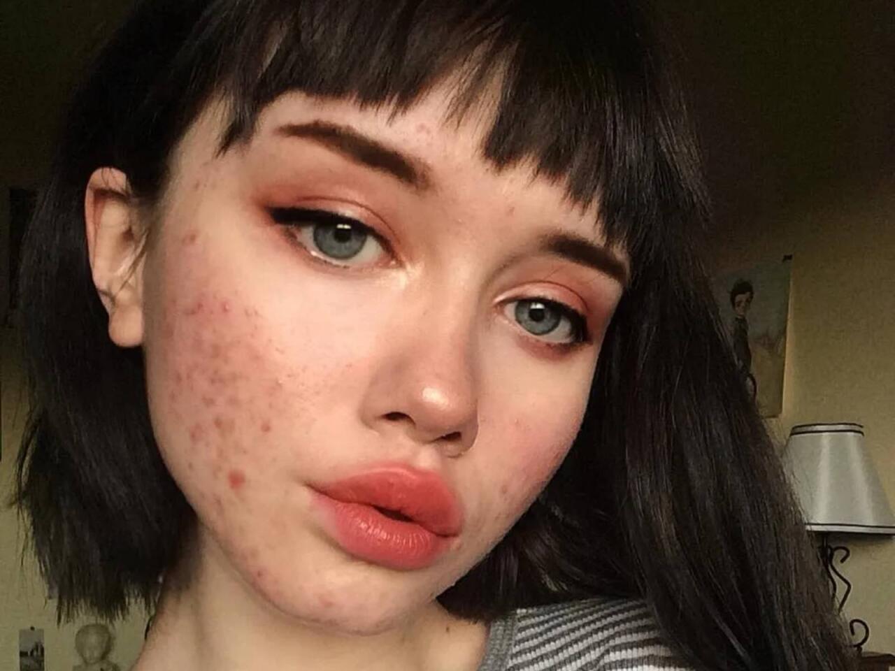 Sızanaqların yaranmasının g&ouml;zlənilməz səbəbi a&ccedil;ıqlandı