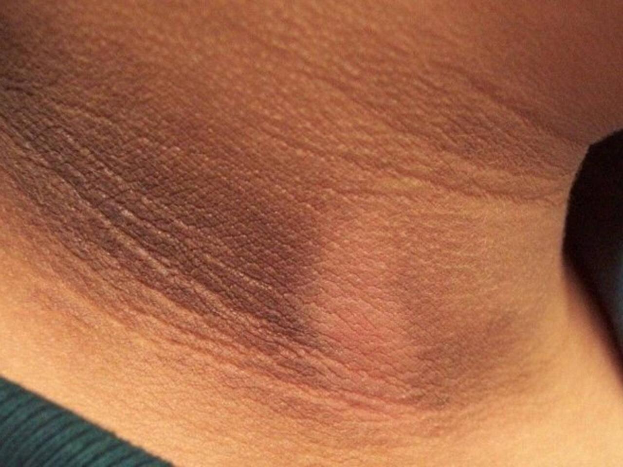 Dibaetin erkən əlamətləri  Dəridə belə izlər yaranır