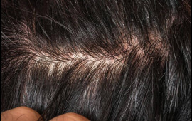 Çox addam ciddiyə almır  Ağır xəstəliklərin əlaməti ola bilər