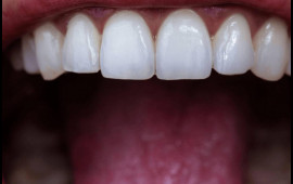 Dişlərin gizli d&uuml;şməni a&ccedil;ıqlandı