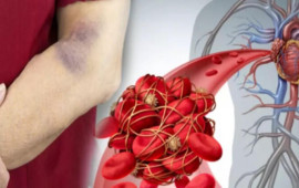 Bu, həyatınızı xilas edə bilər: Qanın laxtalanmasının 5 əlaməti