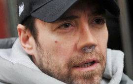 Məşhur m&uuml;ğənni 13c&uuml; dəfə burun əməliyyatı ke&ccedil;irdi 