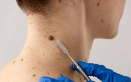 Dəridəki xallar nə vaxt təhl&uuml;kəlidir?  Onkoloqdan a&ccedil;ıqlama